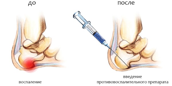 Как вылечить шпору на пятке быстро народными средствами и медикаментозно в домашних условиях