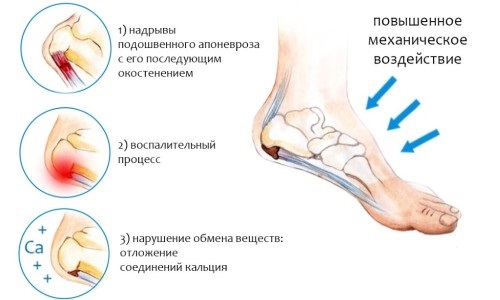 Как вылечить шпору на пятке быстро народными средствами и медикаментозно в домашних условиях