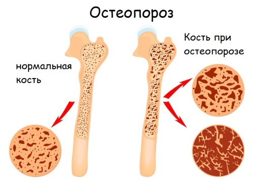 Кортизол повышен у женщин. Причины, симптомы, последствия, лечение в домашних условиях