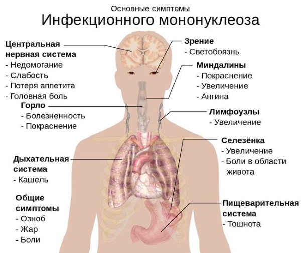 Монокулезная инфекция. Что это такое у детей, взрослых. Фото симптомов, лечение, клинические рекомендации