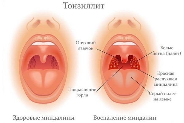 Монокулезная инфекция. Что это такое у детей, взрослых. Фото симптомов, лечение, клинические рекомендации