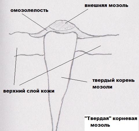 Натоптыши на подошве со стержнем. Причины и лечение мазями, народными средствами в домашних условиях. Фото