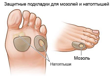 Натоптыши на подошве со стержнем. Причины и лечение мазями, народными средствами в домашних условиях. Фото