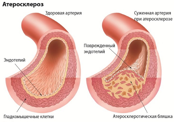 Немеют пальцы рук: причина и лечение: большой, мизинец, безымянный, указательный на левой и правой руке. С каким заболеванием связано