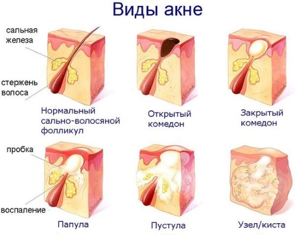 Омега 3. Польза, инструкция по применению для мужчин и женщин. Какие жирные кислоты лучше, в каких продуктах и витаминных комплексах содержатся. Как применять