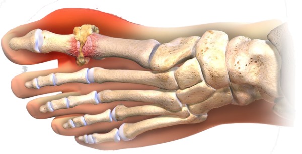 Подагра: что это, признаки и лечение в домашних условиях. Диета, таблетки, народными средствами
