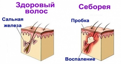 Шампуни от себорейного дерматита для взрослых и детей. Список недорогих, лечебных и эффективных препаратов, цены