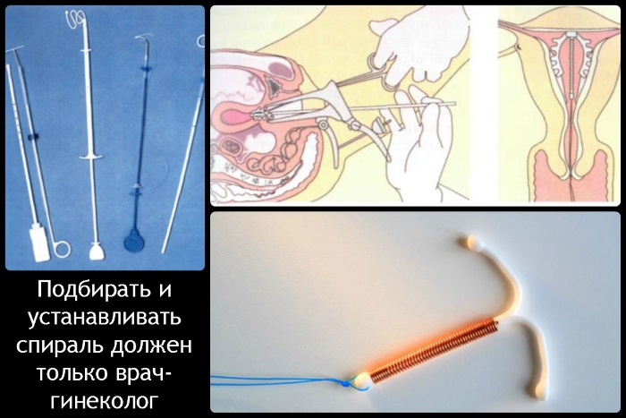 Спираль внутриматочная. Что это такое, виды и цены, как ставят, какая лучше. Список и названия