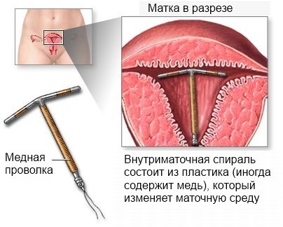 Спираль внутриматочная. Что это такое, виды и цены, как ставят, какая лучше. Список и названия