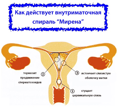 Спираль внутриматочная. Что это такое, виды и цены, как ставят, какая лучше. Список и названия