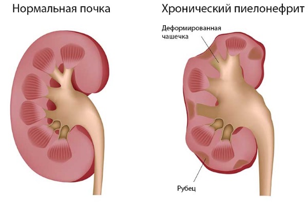 Цистит у женщин: симптомы и лечение, причины. Препараты недорогие и эффективные. Народные средства. Как вылечить быстро хронический, острый, с кровью. Диета