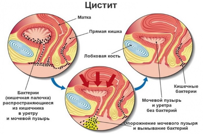 Цистит у женщин: симптомы и лечение, причины. Препараты недорогие и эффективные. Народные средства. Как вылечить быстро хронический, острый, с кровью. Диета