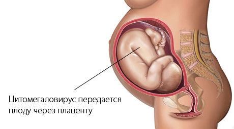 Цитомегаловирус: что это такое. Что значит положительный анализ. Симптомы, лечение. Как передается, проявляется, чем опасен, последствия