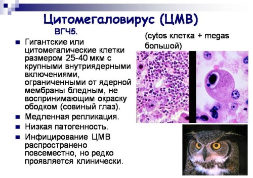 Цитомегаловирус: что это такое. Что значит положительный анализ. Симптомы, лечение. Как передается, проявляется, чем опасен, последствия