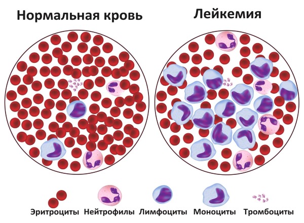 Базофилы повышены в крови у взрослого, ребенка. Причины, о чем это говорит, что делать. Абсолютное содержание, норма