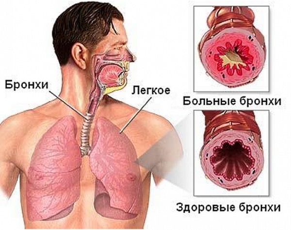 Бронхит. Симптомы и лечение у взрослых в домашних условиях, народными средствами, сколько дней длится, антибиотики