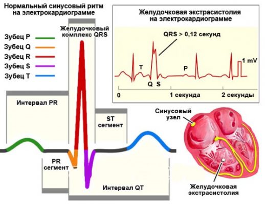 Наджелудочковая экстрасистолия экг фото