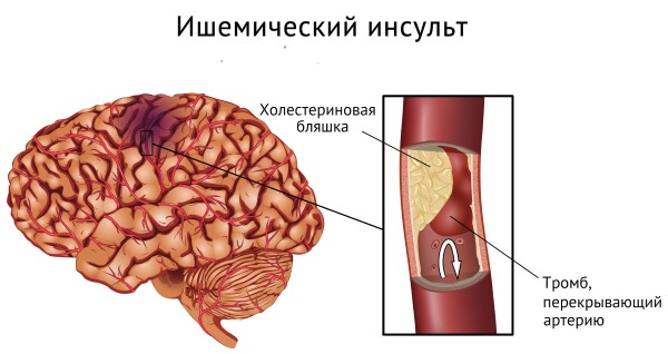 Индометацин. Инструкция по применению препарата в таблетках, свечи, мазь, глазные капли, инъекции. Аналоги