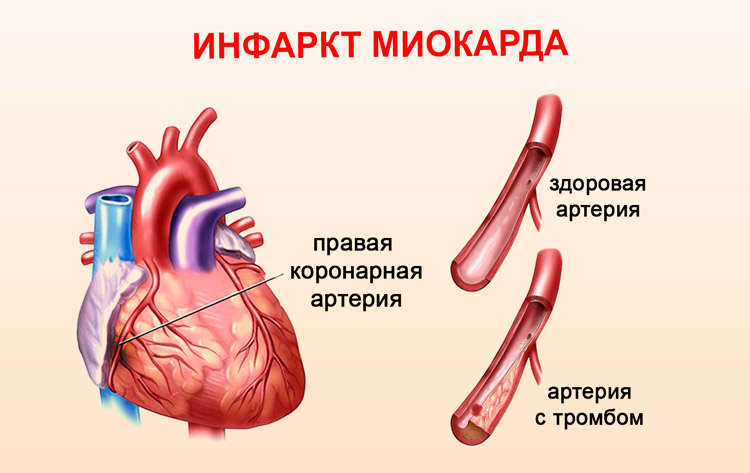 Индометацин. Инструкция по применению препарата в таблетках, свечи, мазь, глазные капли, инъекции. Аналоги