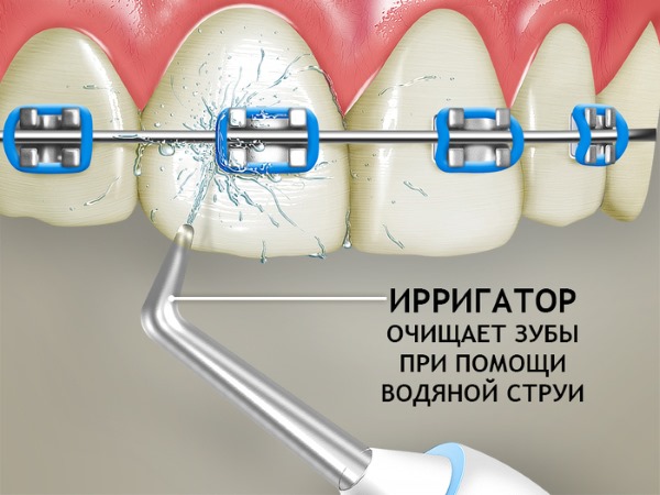 Ирригатор для полости рта. Рейтинг какой лучше, разновидности, особенности применения, преимущества и недостатки