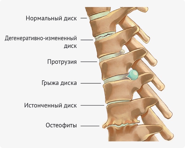 Кинезиотерапия. Что это такое в медицине при грыже поясничного отдела позвоночника, ДЦП, по Бубновскому