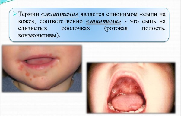 Краснуха у детей. Симптомы и лечение, фото сыпи, стадия, как выглядит, проявляется, переносится, пути передачи. Инкубационный период