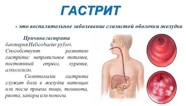 Металлический привкус во рту. Причины с горечью, сухостью, при климаксе, беременности, кашле, после еды