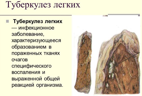 Металлический привкус во рту. Причины с горечью, сухостью, при климаксе, беременности, кашле, после еды