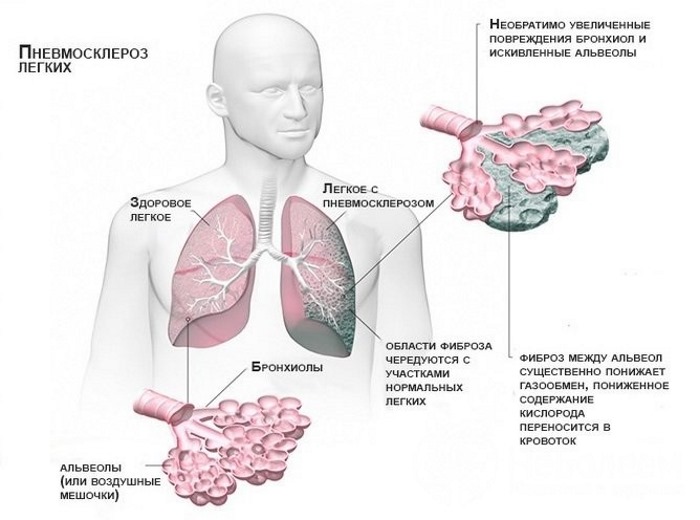 Что такое микоплазма у женщин. Симптомы и лечение народными средствами, препараты. Причины возникновения, как передается, анализ