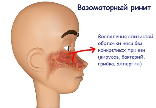 Насморк у грудничка. Причины и симптомы, чем можно и нельзя лечить