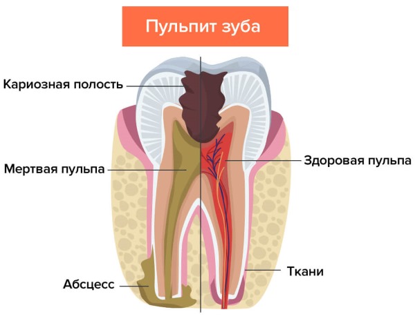 Обезболивающие таблетки при зубной боли после удаления, для беременных, при грудном вскармливании, для детей