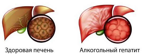 Очищение печени в домашних условиях от шлаков, токсинов. Препараты, народные средства: овес, чага, диета, изюм, шиповник, по Неумывакину