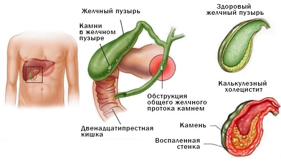 Диета При Циррозе Печени С Асцитом И Сахарном Диабете