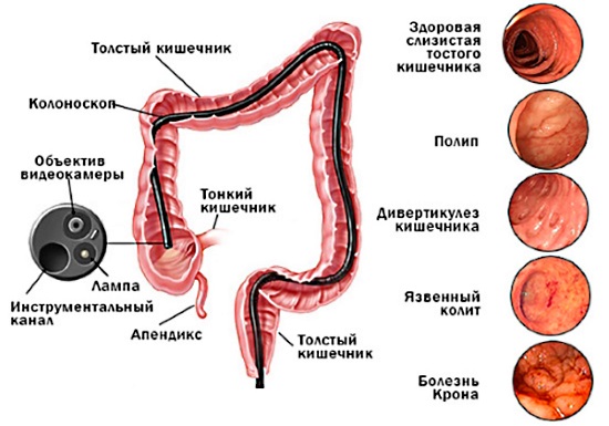 Подготовка к колоноскопии кишечника. Что это такое, как к ней готовиться, бесшлаковая диета, меню, препараты