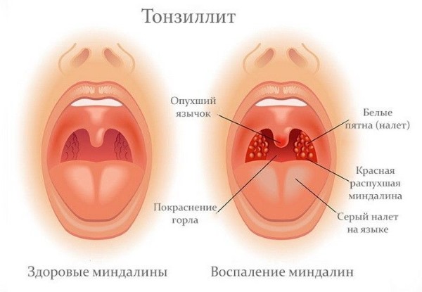 Раствор для полоскания горла: Оки, Фурацилина, сода, соль, йод, Хлорофиллипт, спиртовой, Мирамистин, Йодинол