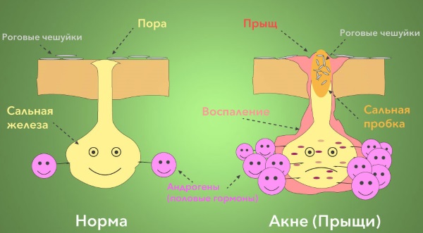 Средства от прыщей для подростков на лице: медикаментозные, косметические, народные