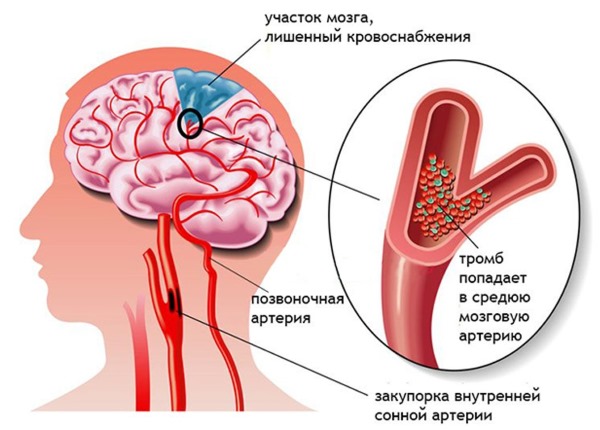 Судороги в ногах. Причины и лечение у пожилых людей, женщин, при беременности, мужчин, ребенка. На какие болезни указывают и что делать