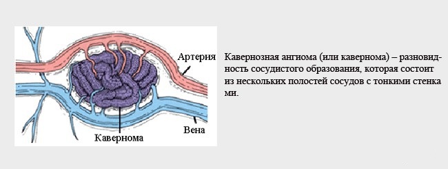 Гемангиома на спине фото