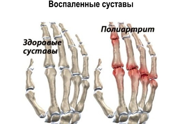 Аркоксия. Состав препарата, показания, инструкция по применению, противопоказания