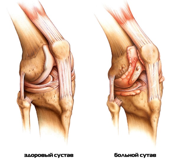 Артрит коленного сустава. Симптомы и лечение, диагностика. Как вылечить ревматоидный, реактивный, подагрический, острый