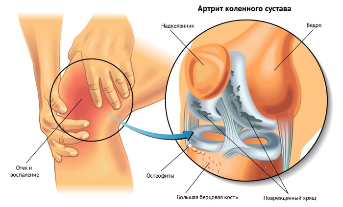 Артрит коленного сустава. Симптомы и лечение, диагностика. Как вылечить ревматоидный, реактивный, подагрический, острый