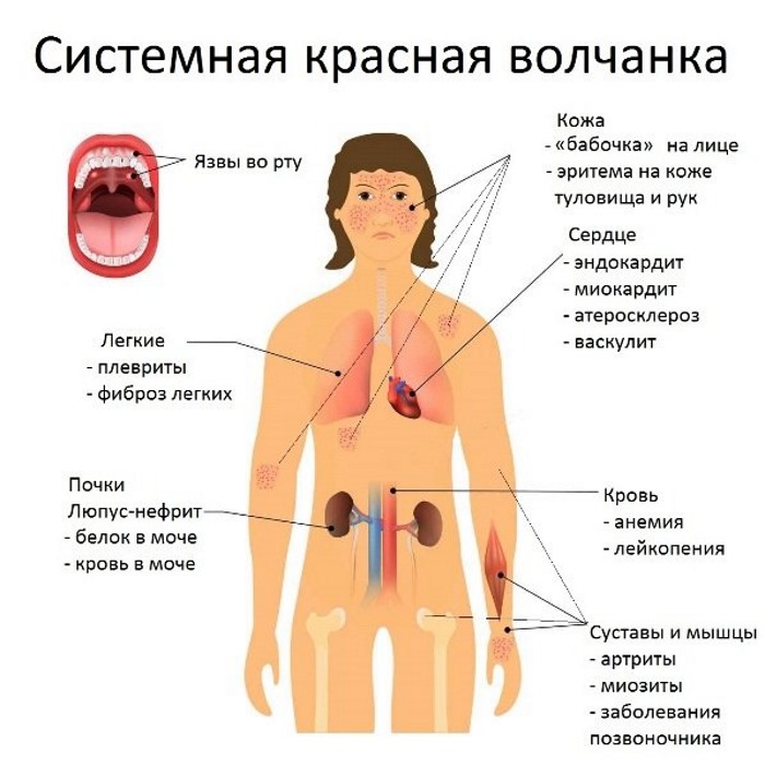 Артрит коленного сустава. Симптомы и лечение, диагностика. Как вылечить ревматоидный, реактивный, подагрический, острый