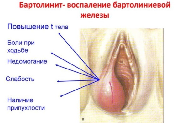 Бартолиновая железа. Где находится у женщин, причины воспаления, лечение в домашних условиях