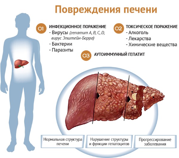 Почему болит печень. Причины и симптомы, как болит у женщин, мужчин после алкоголя, антибиотиков, при беге, беременности. Диагностика и лечение