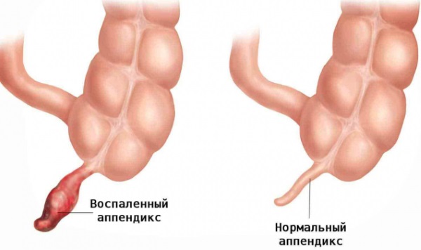 Болит живот у ребенка в области пупка, внизу, левый, правый бок, после еды. Причины и как помочь