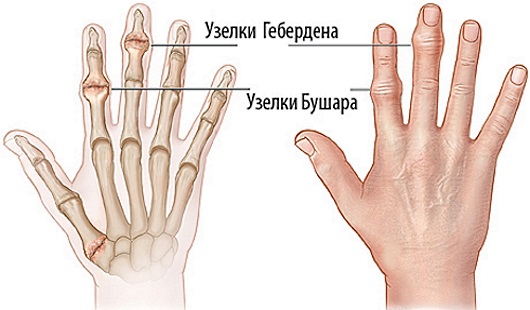 Боли в суставах пальцев рук. Причины и лечение медикаментозными препаратами и народными средствами