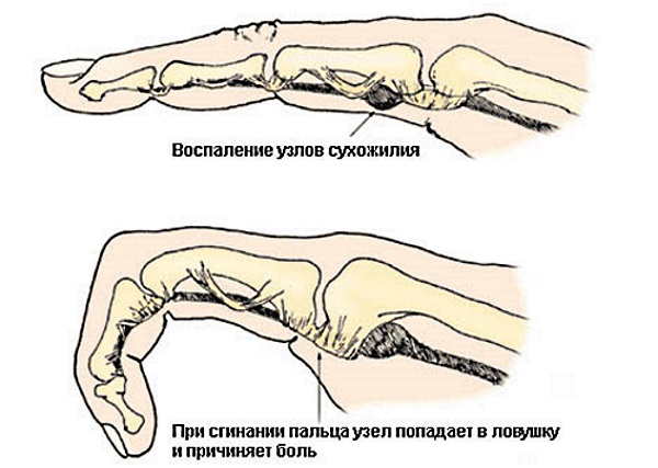 Боли в суставах пальцев рук. Причины и лечение медикаментозными препаратами и народными средствами