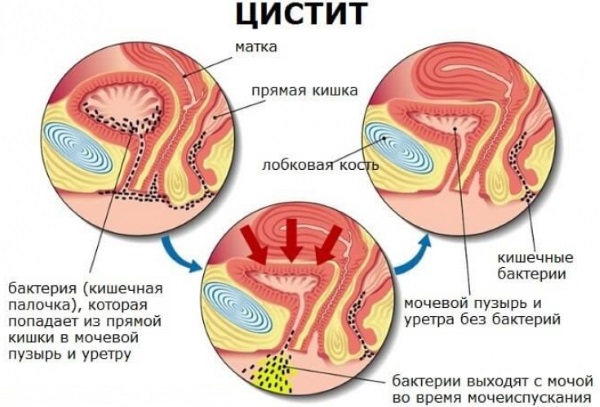 Диета при цистите у женщин, детей, при беременности Список запрещенных и разрешенных продуктов, меню, рецепты