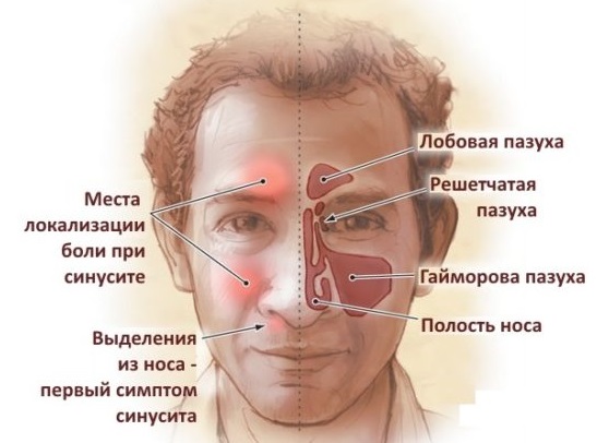 Фронтит симптомы фото