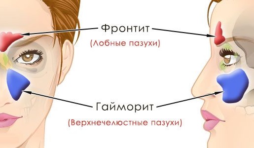 Фронтит. Симптомы и лечение у взрослых, как и чем лечить острый, хронический, катаральный